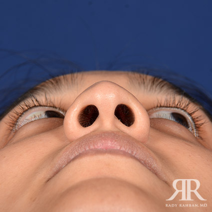 Female Rhinoplasty