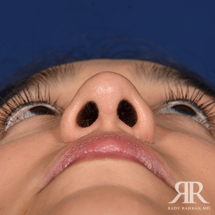 Female Rhinoplasty