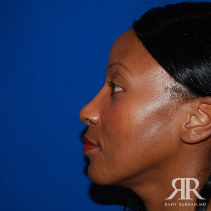 Female Rhinoplasty