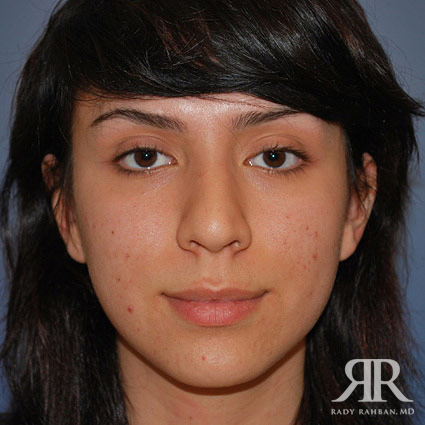 Female Rhinoplasty