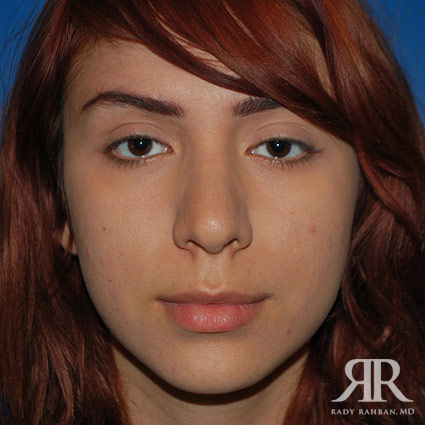 Female Rhinoplasty