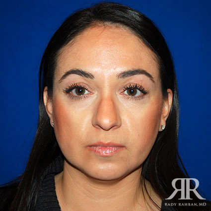 Female Rhinoplasty