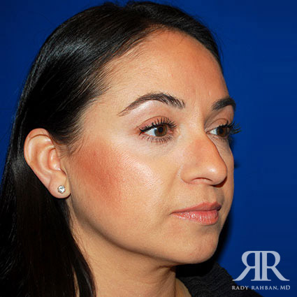 Female Rhinoplasty