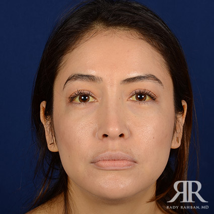 Female Rhinoplasty