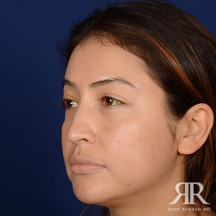 Female Rhinoplasty