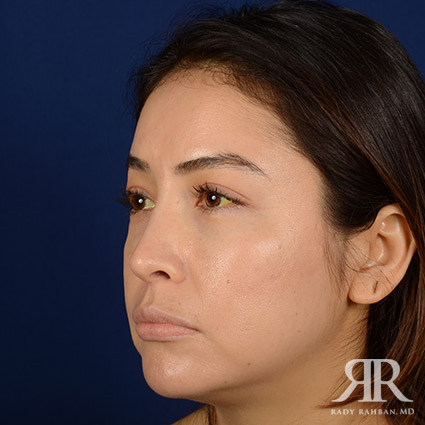 Female Rhinoplasty