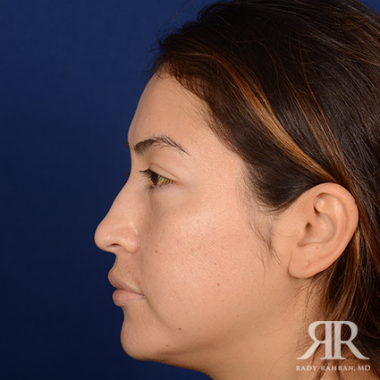 Female Rhinoplasty