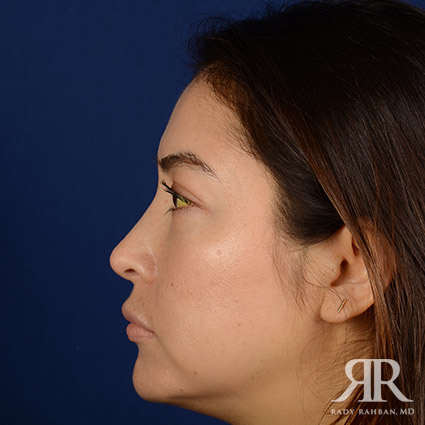 Female Rhinoplasty