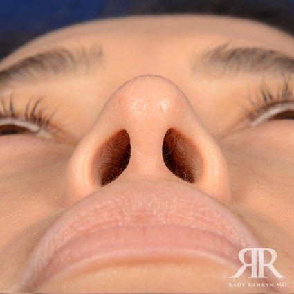 Female Rhinoplasty