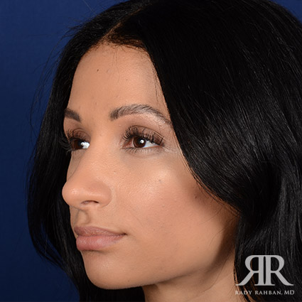 Female Rhinoplasty