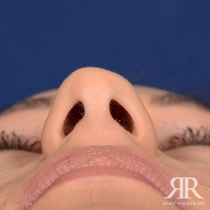 Female Rhinoplasty