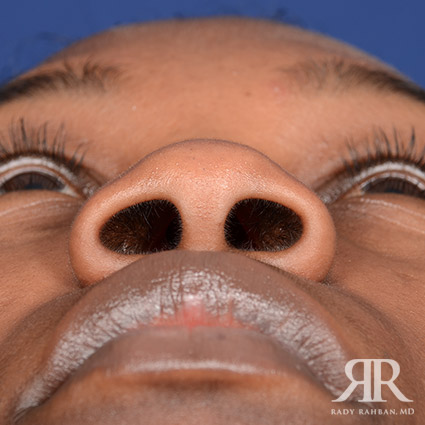 Female Rhinoplasty