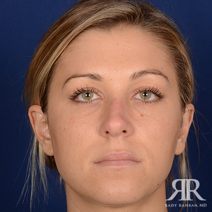 Female Rhinoplasty