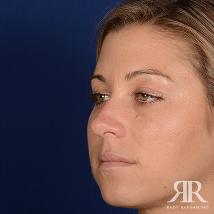 Female Rhinoplasty