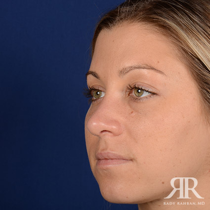 Female Rhinoplasty