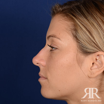 Female Rhinoplasty