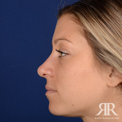 Female Rhinoplasty