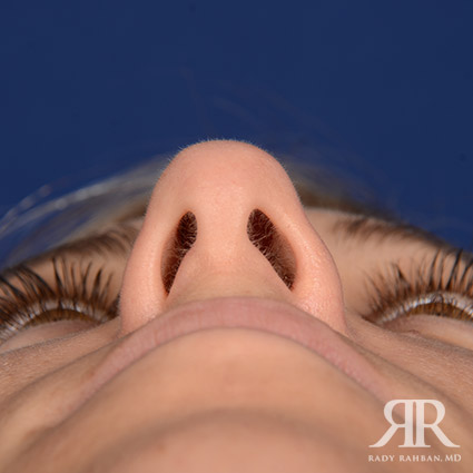 Female Rhinoplasty