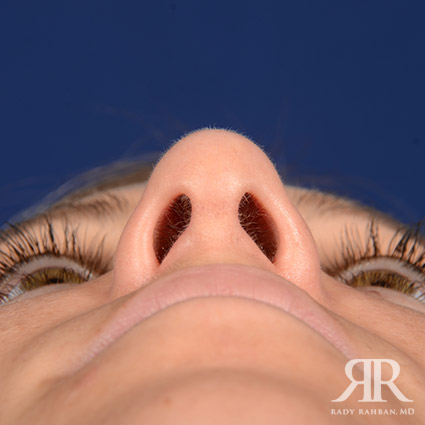 Female Rhinoplasty