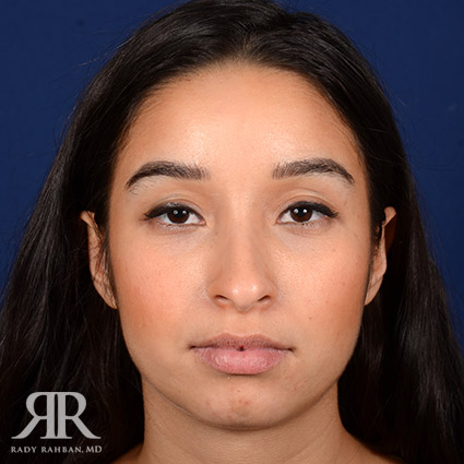 Female Rhinoplasty