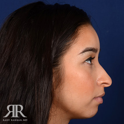 Female Rhinoplasty