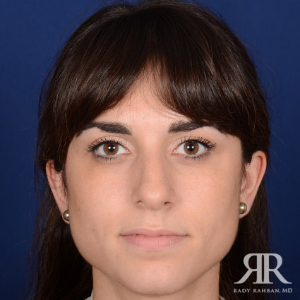 Female Rhinoplasty