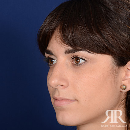 Female Rhinoplasty