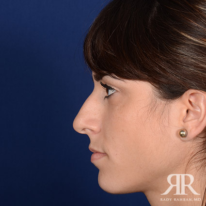 Female Rhinoplasty