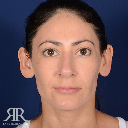 Female Rhinoplasty