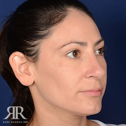 Female Rhinoplasty