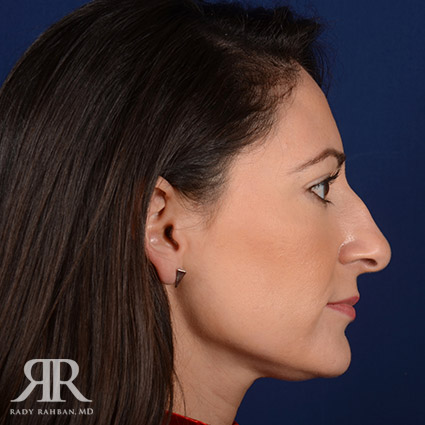 Female Rhinoplasty