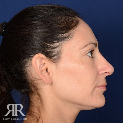 Female Rhinoplasty