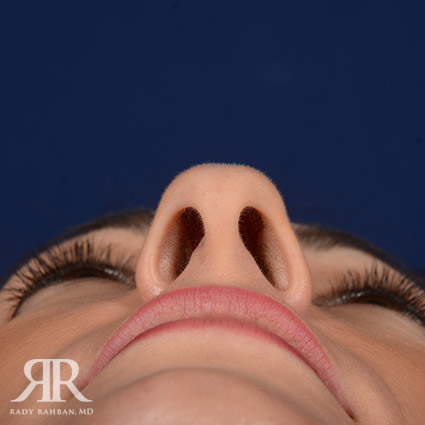 Female Rhinoplasty