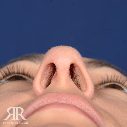 Female Rhinoplasty