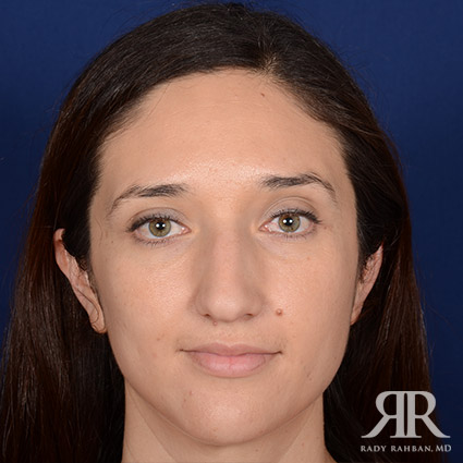 Female Rhinoplasty