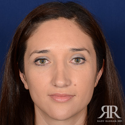 Female Rhinoplasty