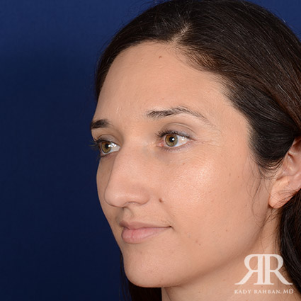 Female Rhinoplasty