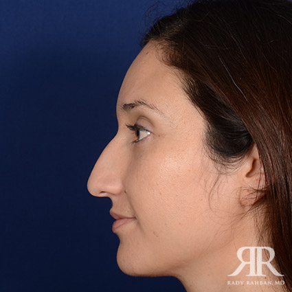 Female Rhinoplasty