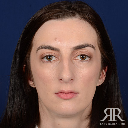 Female Rhinoplasty