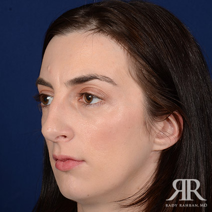 Female Rhinoplasty