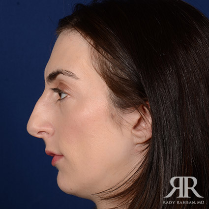 Female Rhinoplasty