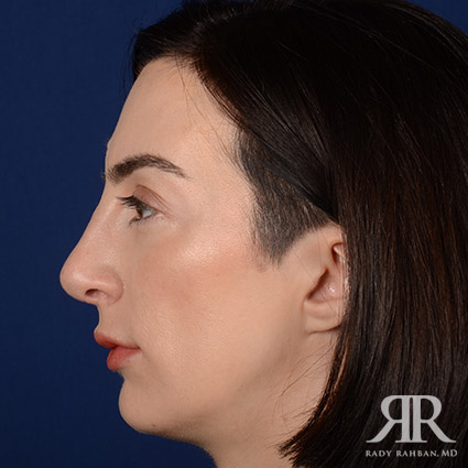 Female Rhinoplasty