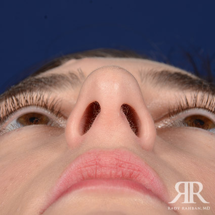 Female Rhinoplasty