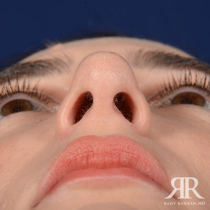 Female Rhinoplasty