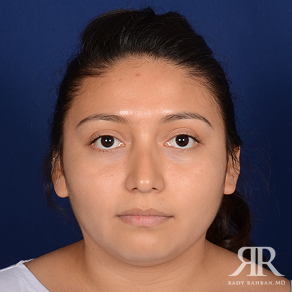 Female Rhinoplasty