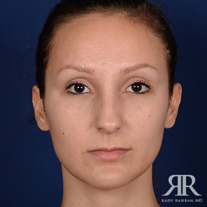 Female Rhinoplasty