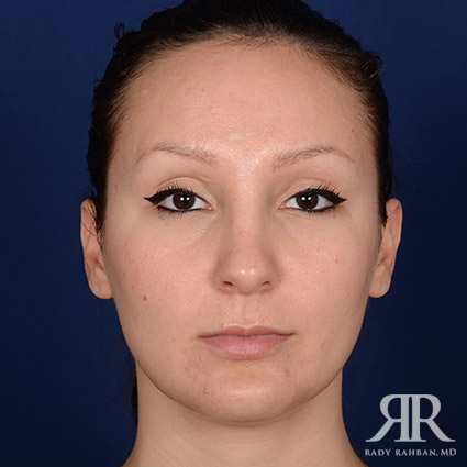 Female Rhinoplasty