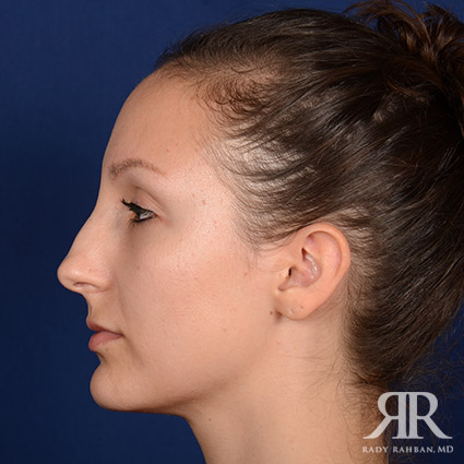 Female Rhinoplasty