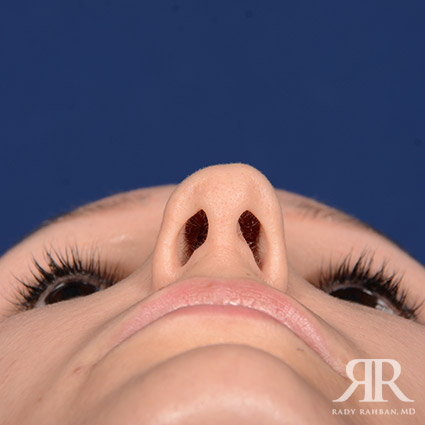 Female Rhinoplasty