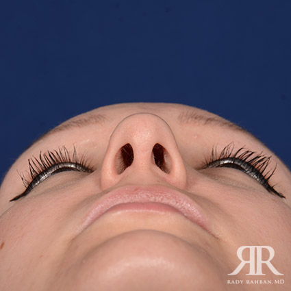 Female Rhinoplasty